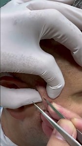 Ingrown hair extractions Blackheads PimplePopping İngrownhairs