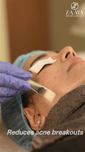 Clear skin starts with the right peel ✨ Acne Buster Peel working beneath the surface✨