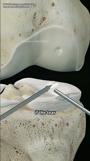 Knee Arthroscopy-Meniscal Surgery (3d animation)#kneearthroscopy #meniscussurgery #kneesurgery