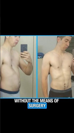 Severe Pectus Excavatum - Life Changing Transformation