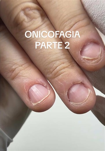 Ricomposizione Unghie: Gel vs Acrilico