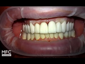 Протезирование зубов. Фиксация временных коронок. Часть 1.