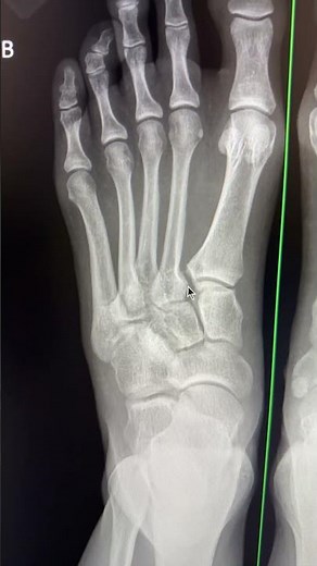 Lisfranc injury #radiology #mskradiology #foot #lisfranc