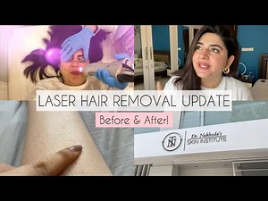 Full Body Laser Hair Removal Update | Does it Make a Difference? GlossipsVlogs