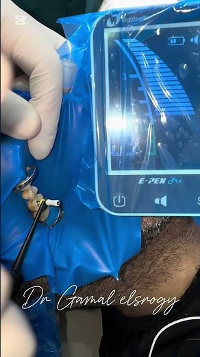 How to Pre-bend Endodontic Files Clinical Tip for Curved Root Canals