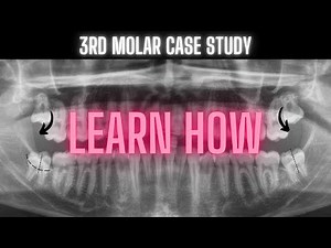 Third Molar Impaction Video | Learn How • Video • MEDtube.net