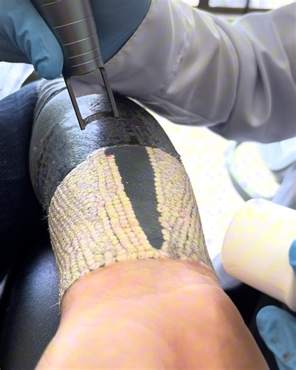 Removing a blackout tattoo is not a simple process, and takes multiple sessions of laser removal 😲 | UNILAD Tech