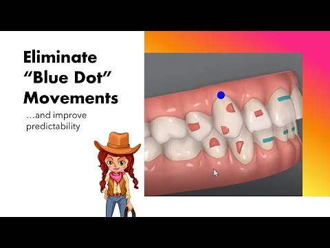 Invisalign ClinCheck - Eliminate "Blue Dot" TMA Movements