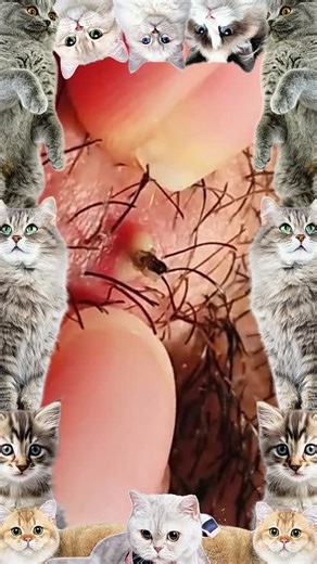 Ultimate Cyst and Blackhead Extraction Techniques