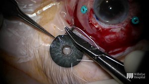 IOL Exchange and Iris Prosthesis - Eyetube