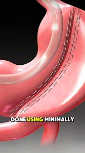 175K views · 1.7K reactions | How Sleeve Gastrectomy Surgery is Performed? (3D Animation) #How #sleeve #sleevegastrectomy #gastrectomy #surgery #surgeon #doctor #hormones #stomach #surgical #medical3danimation #3dmedicalanimation | Medcare777 | Facebook