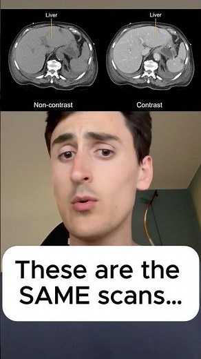 Contrast Explained in CT