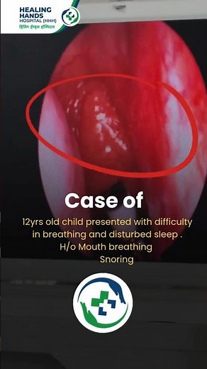 Adenoidectomy Surgery