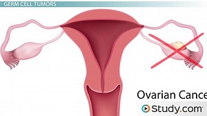 Ovarian Disorders: Types of Ovarian Cancer