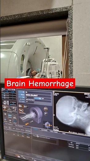 Brain Hemorrhage CT Scan