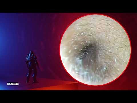 The Truth About earwax Will Shock You. How to remove earwax from ear, earwax extractions