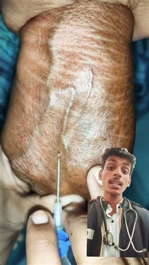 IV Cannula Insertion 😮‍⚕️ | Nursing Skills | #nursing​ #skills​ #shorts​ #youtubeshorts​ #trending​