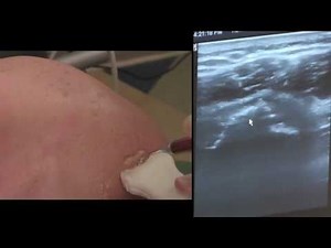 PRP (Platelet Rich Plasma) Ultrasound-guided injection of the Shoulder: Dr. Marc Darrow, M.D., J.D.