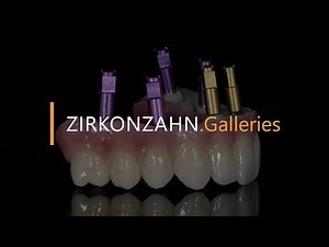 Removable Prettau® Bridge on six Implants | Zirkonzahn.Galleries