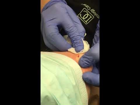 Cyst extraction on chin