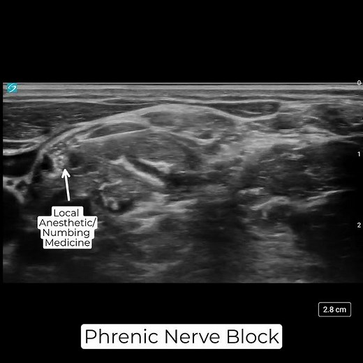 Phrenic Nerve Block for Hiccups
