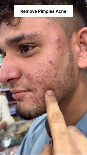 Remove Pimples Acne Naturally at Home | Get Clear Spotless Skin ✨ Pimples Removal Tips #acne #hack