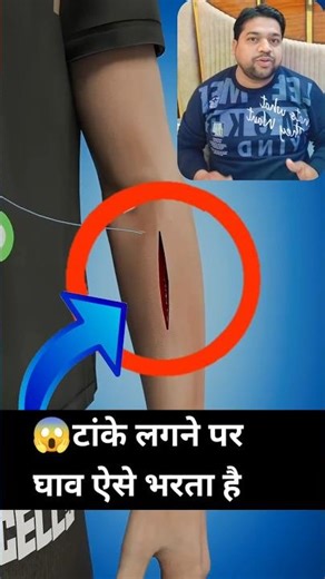 stretcher के बाद ऐसे घाव भरता हैं #shortsfeed #trending #popular #medical #neet #doctor #viralreels