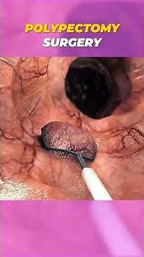 Polypectomy Surgery Explained | 3D Animation in 60 Seconds #3danimation #facts #medicalshorts