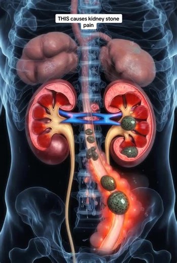Understanding Kidney Stone Pain: Causes and Solutions