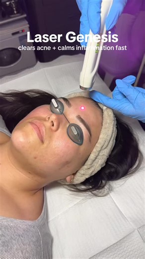 ✨ Laser Genesis for Acne ✨�If you’ve been struggling with active breakouts or stubborn texture, Laser Genesis is one of the treatments that can truly change your skin. It works by gently heating the dermis to kill acne bacteria, calm inflammation, and smooth out texture over time. Most clients start seeing clearer, calmer skin after just a few sessions and the best part? You can do multiple sessions in a week for faster results. Ready for your glow up? Book your Laser Genesis consultation today 