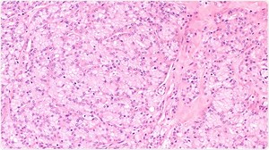 Acinic Cell Carcinoma