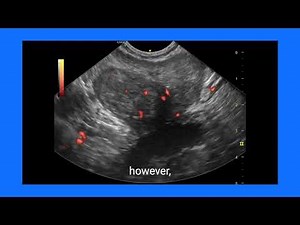 Prostate Cancer Diagnosis: Ultrasound and Color Doppler Findings Explained