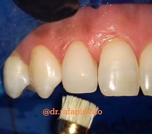 Dr. Rafa Piñeiro on Instagram: "Direct veneer on 12 with microdontia after orto treatment. Final gloss 😃 ! In dentistry “less is more”, just one layer to imitate perfectly adjacent teeth 😉. Brillo final de carilla de composite sobre el 12 microdontico. En Odontología “menos es más”, en este caso una simple capa de composite para imitar fielmente los dientes adyacentes😃😉 ! #dental #dentalesthetics #aestheticdentistry #compositeveneers #carillasdecomposite #allaboutesthetics2023"