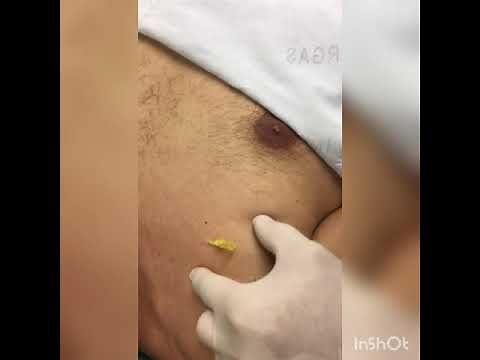 Técnica de Hipodermóclise e Administração de Medicamentos e Fluidos