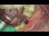 Restoration Digital Work Flow After Immediate Implant • Video • MEDtube.net
