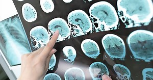 What new guidelines say to do to prevent a stroke