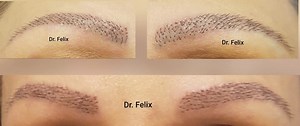 Implant de sprancene - Dr Felix Hair Implant