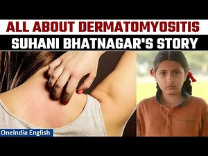 Dermatomyositis: All About the Cause of 'Dangal' Actor Suhani Bhatnagar's Demise | Oneindia News