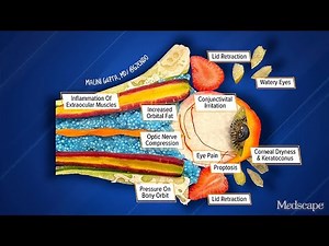 Illustrating the Progression of Thyroid Eye Disease