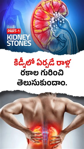 LohithSai Super Speciality Hospitals Siddipet on Instagram: "Kidney stones are a common but painful urinary condition that can affect anyone. These hard mineral deposits form in the kidneys due to dehydration, high salt intake, poor diet, or metabolic disorders. 🔹 Types of Kidney Stones: • Calcium stones (most common) • Uric acid stones • Struvite stones • Cystine stones 🔹 Common Causes of Kidney Stones: • Drinking less water • High salt and protein diet • Recurrent urinary infections • Obesit