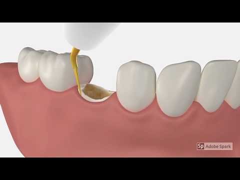 Video Tutorial: Tooth Extraction with Piezosurgery