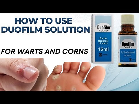 Duofilm Solution Uses||How to Get Rid of Warts, Corns, and Calluses with Duofilm Solution.