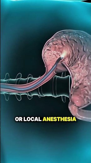 Gastroscopy Procedure | 3D Animation#Gastroscopy #Endoscopy #3DAnimation #StomachScan #Medical