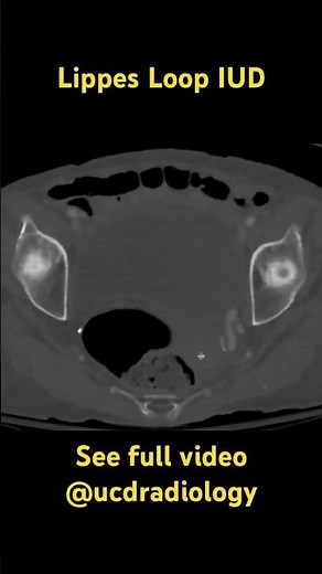 Lippes loop IUD #medicine #radiology #doctor #gynecologist #medicalstudent