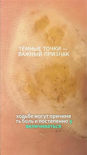 Мозоль или подошвенная бородавка? Главный признак