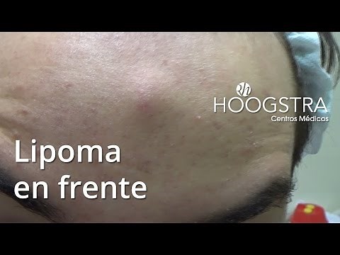 Forehead Lipoma Removal (15145)