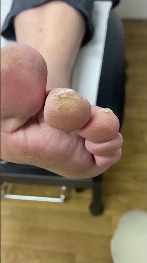 Quick & Painless Callus Removal by Expert Australian Podiatrist