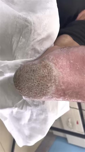 Fixing Curled Toenails with Detailed Pedicure Process U199 #ingrownnail #FootTreatment #SatisfyingClip #toenailremoval #MustWatch Disclaimer: This video is for educational and relaxation purposes only. All content belongs to the respective owners, no copyright infringement is intended. | Video box1