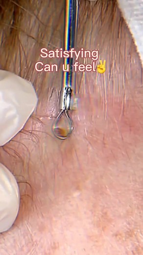 #oddlysatisfying #drpimplepop #skincare #satisfying #popping #drpimplepop #zitpop #cystpopping #pimple #zit can u feel?