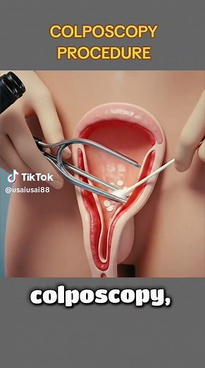 Understanding the Colposcopy Procedure: A 3D Animation Guide
